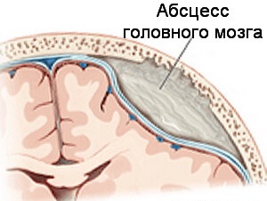 Абсцесс голоного мозга